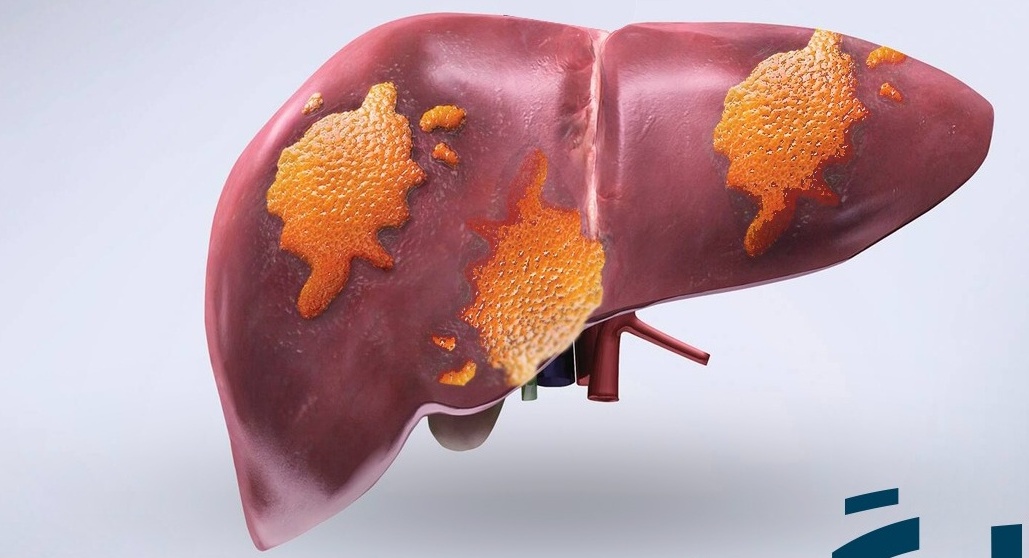 الكبد الدهني والدهني الكحولي